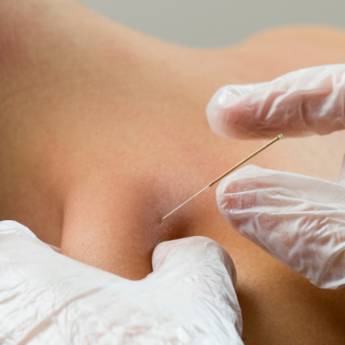 Comprar o produto de Dry Needling para Alívio de Dores Musculares em Bauru/SP  em Fisioterapia em Bauru, SP por Solutudo