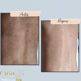 Comprar o produto de Depilação Costas em Depilação em Mineiros, GO por Solutudo