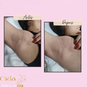 Comprar o produto de Depilação Axila  em Depilação em Mineiros, GO por Solutudo