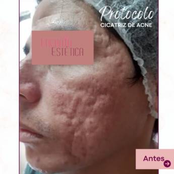 Comprar o produto de Microagulhamento – Redução de Cicatrizes de Acne com Estímulo Natural de Colágeno – Rio de Janeiro, RJ em Clínicas de Estética e Beleza em Rio de Janeiro, RJ por Solutudo