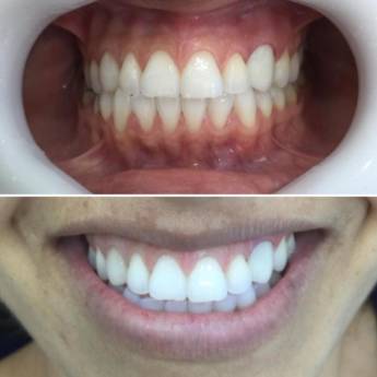 Comprar o produto de Clareamento Dental em Hortolândia – Odonto Los Angeles em Odontologia em Hortolândia, SP por Solutudo