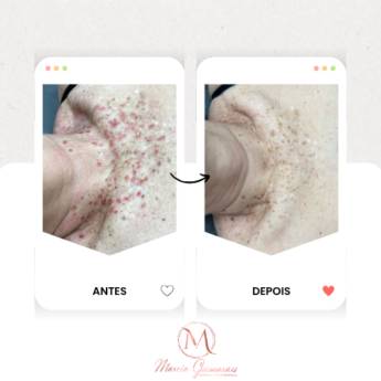 Comprar o produto de Remoção de Verrugas e Sinais na Pele em Goiatuba – Estética e Segurança em Clínicas de Estética e Esteticistas em Goiatuba, GO por Solutudo Comprar o produto de Remoção de Verrugas e Sinais na Pele em Goiatuba – Estética e Segurança em Clínicas de Estética e Esteticistas em Goiatuba, GO por Solutudo