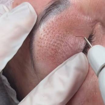 Comprar o produto de Jato de Plasma em São Manuel – Rejuvenescimento Preciso e Duradouro em Clínicas de Estética e Esteticistas em São Manuel, SP por Solutudo