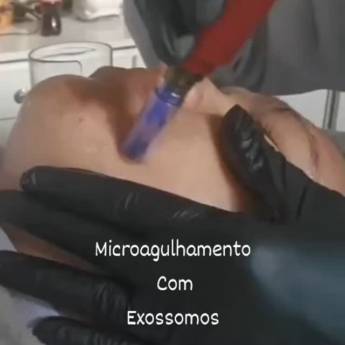 Comprar o produto de Microagulhamento em São Manuel – Rejuvenescimento com Resultados Visíveis em Clínicas de Estética e Esteticistas em São Manuel, SP por Solutudo