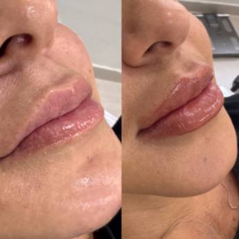 Comprar o produto de  BIOLIPS em Jundiaí em Beleza, Estética e Bem Estar em Jundiaí, SP por Solutudo