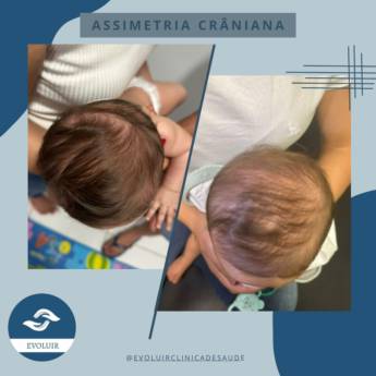 Comprar o produto de Assimetria Craniâna  em Fisioterapia em Mineiros, GO por Solutudo