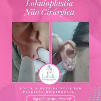 Comprar o produto de Lobuloplastia Não Cirúrgica em Avaré – Recuperação Estética Sem Cirurgia em Consultoria em Saúde em Avaré, SP por Solutudo