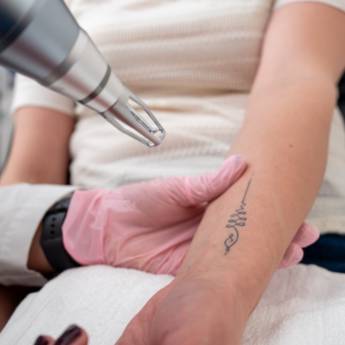 Comprar o produto de Remoção de Tatuagem em Tatuagem em Bauru, SP por Solutudo