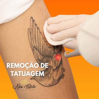 Comprar o produto de Remoção de Tatuagem em Estética Corporal em Foz do Iguaçu, PR por Solutudo Comprar o produto de Remoção de Tatuagem em Estética Corporal em Foz do Iguaçu, PR por Solutudo