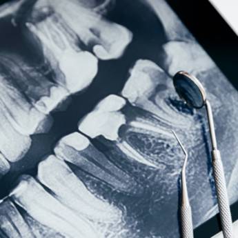 Comprar o produto de Rx Interproximal - Diagnóstico Preciso e Eficiente em Lençóis Paulista, SP em Estética Odontológica em São Manuel, SP por Solutudo