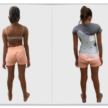 Comprar o produto de Colete 3D Rigo-Chêneau - Correção Eficiente da Escoliose em Ribeirão Preto/SP em Coletes em Franca, SP por Solutudo