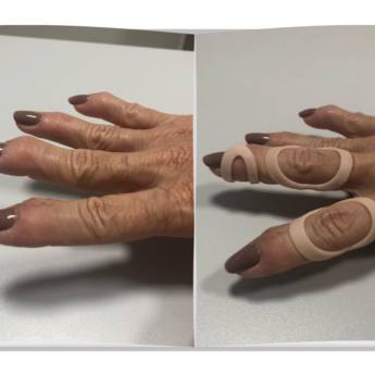 Comprar o produto de Anel em Oito em Impressão 3D - Prevenção e Correção de Deformidades em Ribeirão Preto/SP em Anéis em Franca, SP por Solutudo