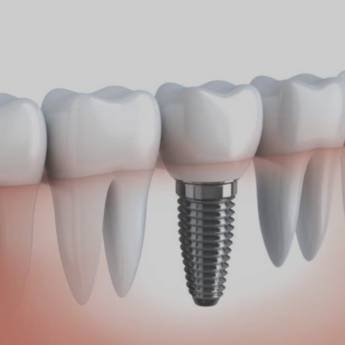 Comprar o produto de Implantes Dentários Porcelana - Beleza e Durabilidade - Macatuba em Odontologia em Pederneiras, SP por Solutudo