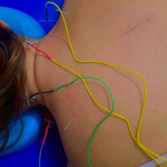 Comprar o produto de Dry Needling com Eletroestimulação – Alívio Rápido de Dores em São José dos Campos/SP em Fisioterapia em São Paulo, SP por Solutudo