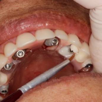 Comprar o produto de Implantes em Prótese sobre Implantes: Sorria Com Confiança em Uberlândia/MG em Odontologia em Patrocínio, MG por Solutudo