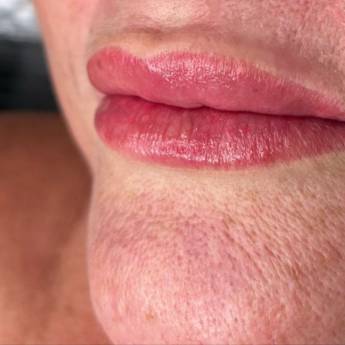 Comprar o produto de Microlabial em Clínicas de Estética e Esteticistas em Lagoa Santa, MG por Solutudo