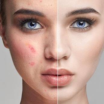 Comprar o produto de Tratamentos para Acne em Estética Facial em Atibaia, SP por Solutudo