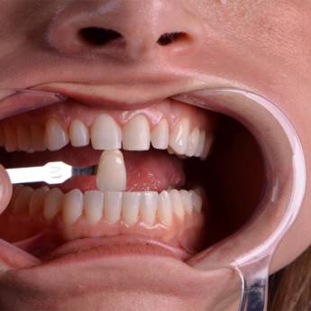 Comprar o produto de FACETAS DENTÁRIAS em Saúde Dental em Americana, SP por Solutudo