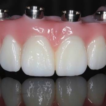 Comprar o produto de Protese sobre implante - PROTOCOLOGO em A Classificar em Bauru, SP por Solutudo