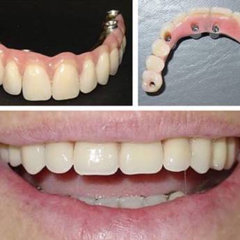 Comprar o produto de Protese sobre implante - PROTOCOLOGO em A Classificar em Bauru, SP por Solutudo