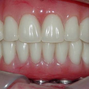 Comprar o produto de Protese sobre implante - PROTOCOLOGO em A Classificar em Bauru, SP por Solutudo