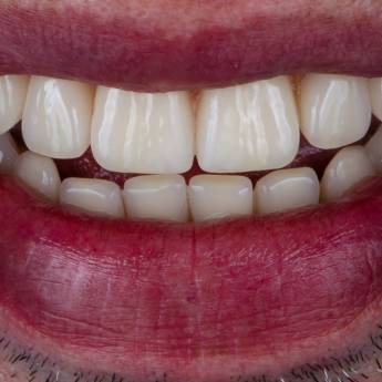 Comprar o produto de Prótese Protocolo em Francisco Beltrão – Segurança e Sorrisos Renovados em Odontologia em Francisco Beltrão, PR por Solutudo Comprar o produto de Prótese Protocolo em Francisco Beltrão – Segurança e Sorrisos Renovados em Odontologia em Francisco Beltrão, PR por Solutudo