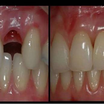Comprar o produto de Protese sobre implante - COROA  em A Classificar em Bauru, SP por Solutudo