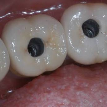 Comprar o produto de Protese sobre implante - COROA  em A Classificar em Bauru, SP por Solutudo