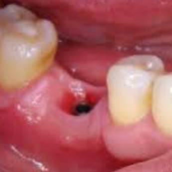 Comprar o produto de Protese sobre implante - COROA  em A Classificar em Bauru, SP por Solutudo