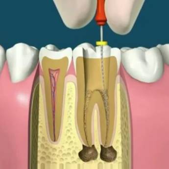 Comprar o produto de Tratamento de canal em A Classificar em Bauru, SP por Solutudo