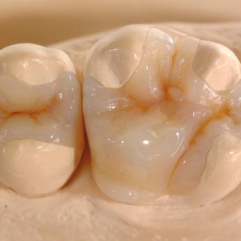 Comprar o produto de Inlay/Onlay em Odontologia em Bauru, SP por Solutudo