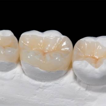 Comprar o produto de Inlay/Onlay em Odontologia em Bauru, SP por Solutudo