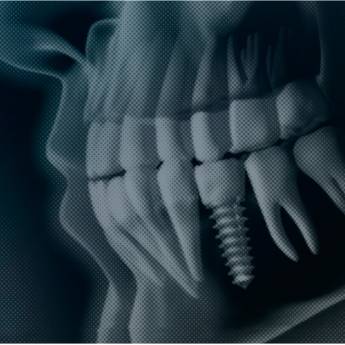 Comprar o produto de Guia Cirúrgico para Implantes em Odontologia Digital em Atibaia, SP por Solutudo