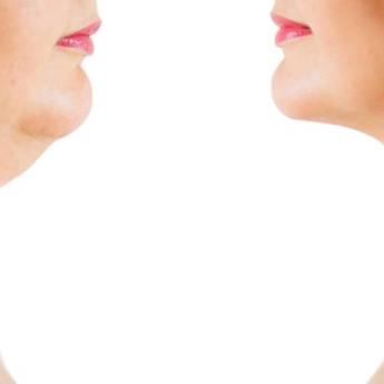 Comprar o produto de Lipo de papada em Odontologia em Resende, RJ por Solutudo