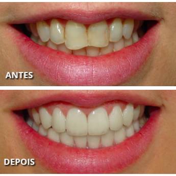 Comprar o produto de Facetas em Odontologia em Bauru, SP por Solutudo