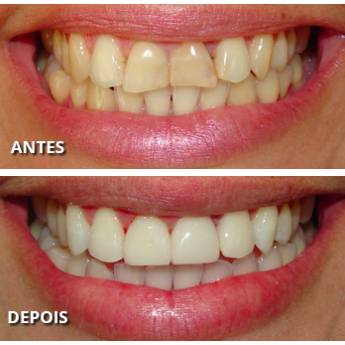 Comprar o produto de Facetas em Odontologia em Bauru, SP por Solutudo