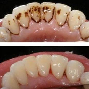 Comprar o produto de Raspagem Periodontal  em A Classificar em Bauru, SP por Solutudo