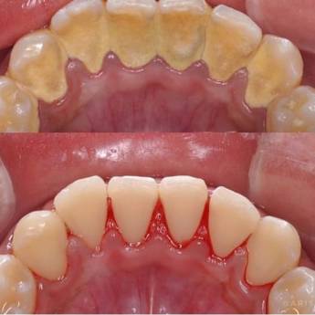 Comprar o produto de Raspagem Periodontal  em A Classificar em Bauru, SP por Solutudo