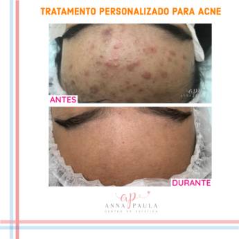 Comprar o produto de Tratamento para Cicatrizes de Acne em Estética Facial em Aracaju, SE por Solutudo