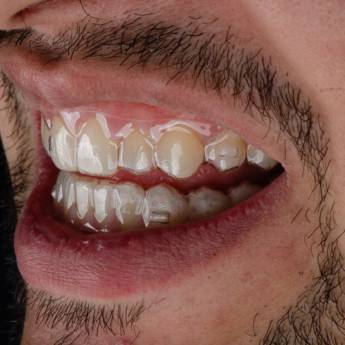 Comprar o produto de Alinhadores Ortodôntico em Francisco Beltrão – Discrição e Conforto no Seu Sorriso em Odontologia em Francisco Beltrão, PR por Solutudo Comprar o produto de Alinhadores Ortodôntico em Francisco Beltrão – Discrição e Conforto no Seu Sorriso em Odontologia em Francisco Beltrão, PR por Solutudo