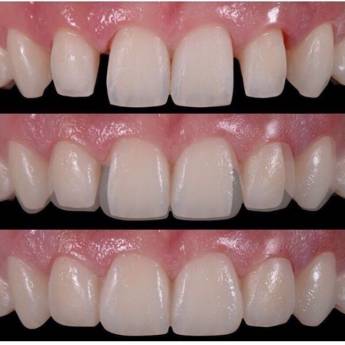 Comprar o produto de Faceta  em A Classificar em Bauru, SP por Solutudo