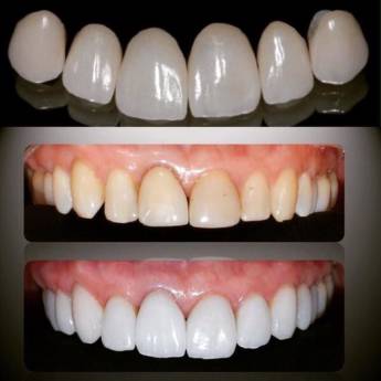 Comprar o produto de Faceta  em A Classificar em Bauru, SP por Solutudo