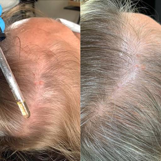Comprar o produto de Tratamento para Alopecia em Nossos Serviços pela empresa Eulália Brasil Terapeuta Capilar em Americana, SP por Solutudo