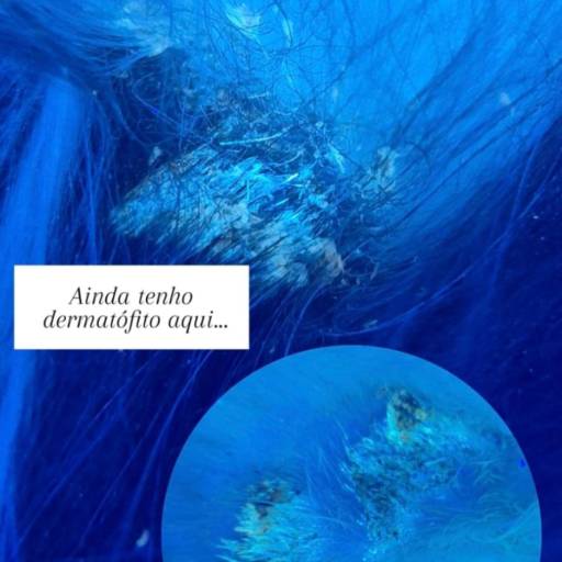 exame específicos para diagnóstico de fungo ou dermatite ocasionada por fungo