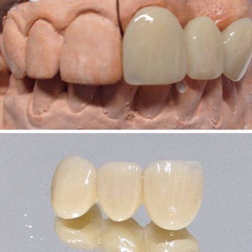 Prótese Fixa (“coroa de porcelana ou jaqueta”) por Dra. Nathália Quirino Bueno