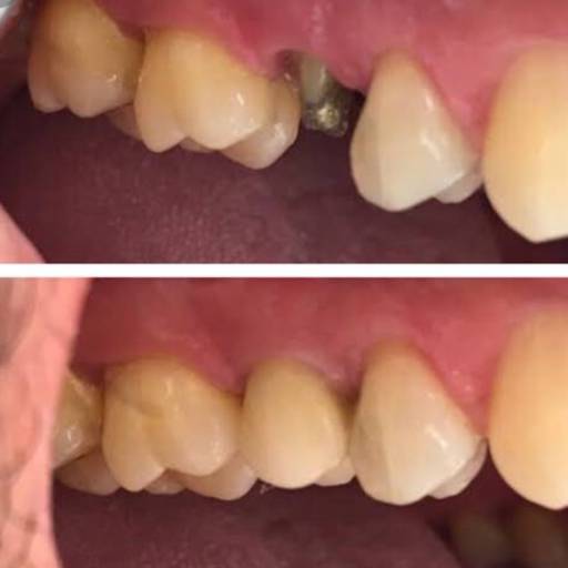 Prótese Fixa (“coroa de porcelana ou jaqueta”) por Dra. Nathália Quirino Bueno