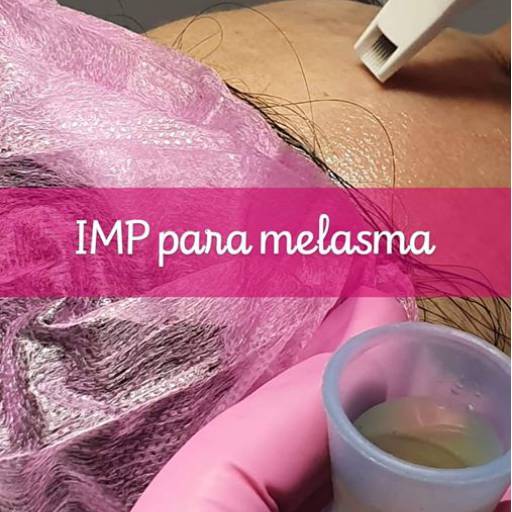 Tratamento para Melasma  por Consultório Dra. Giovana Rufino CRM: 98663 - SP