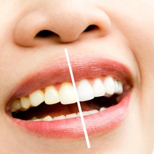 Clareamento Dental  em Americana, SP por Dra. Ana Barros - Odontologia e Estética 