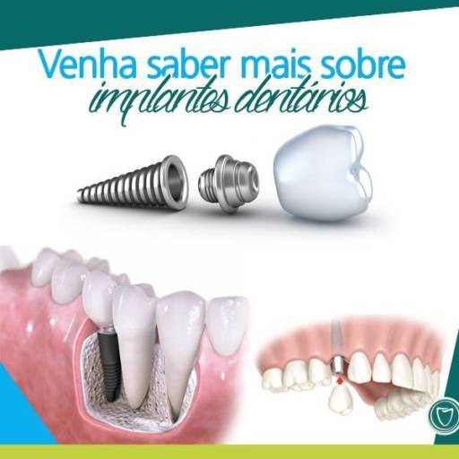 Comprar o produto de Implante Dentario em A Classificar pela empresa Squadra Odontologia Integrada em Foz do Iguaçu, PR por Solutudo