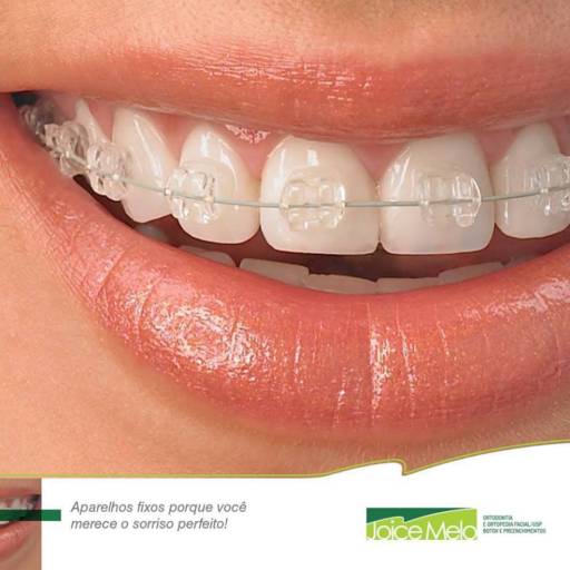 Comprar o produto de Aparelhos Ortodonticos em Odontologia pela empresa Clínica Joice Melo em Mineiros, GO por Solutudo